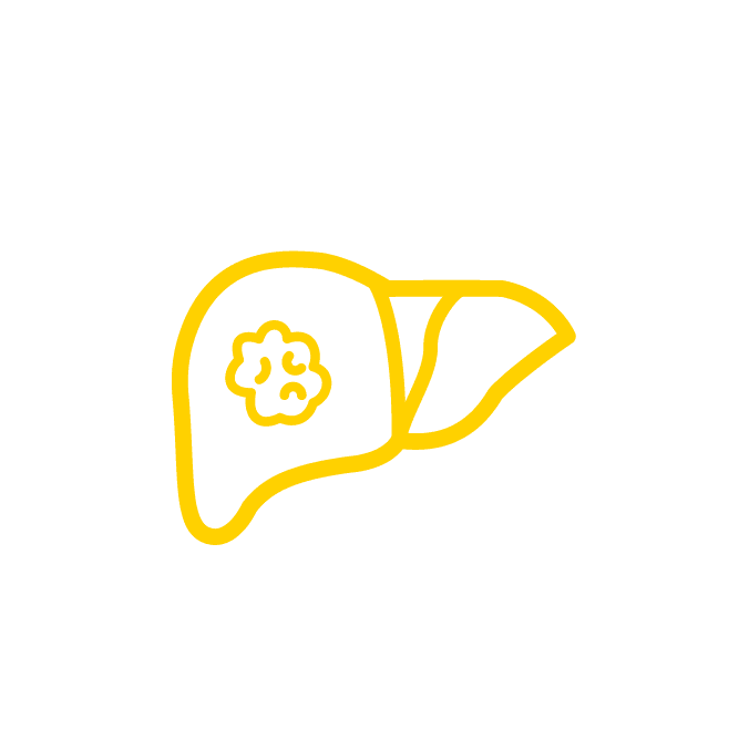 أورام سرطان الكبد