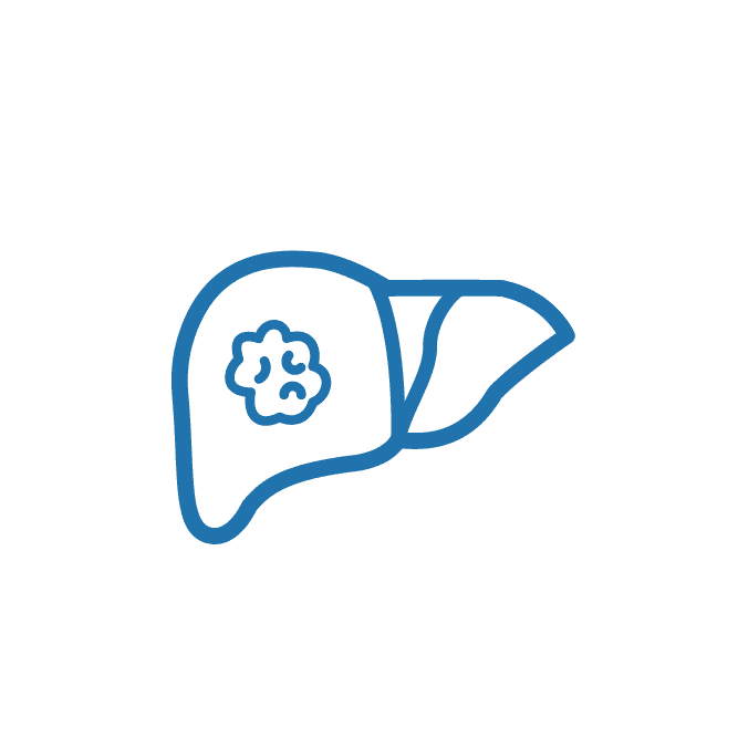 أورام سرطان الكبد