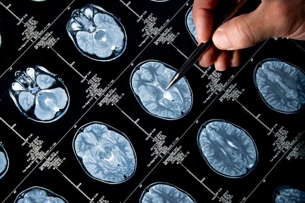 طب أورام المخ للأطفال